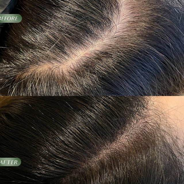 smp-micropigmentation